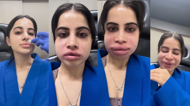 उर्फी जावेद के एक फैसले ने बिगाड़ दिया पूरा चेहरा, सूजे होंठ और लाल हुआ चेहरा, वायरल हुआ वीडियो!