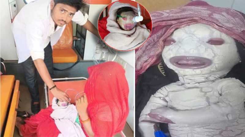 मध्य प्रदेश में जन्मा 'एलियन' जैसा बच्चा, खतरनाक बीमारी से ग्रसित, हालत नाजुक