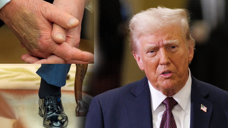 पैरों में सूजन, हाथों पर निशान… इस गंभीर बीमारी की चपेट में आ गए ट्रंप, व्हाइट हाउस ने किया खुलासा